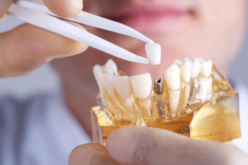 implante dental en A Coruña
