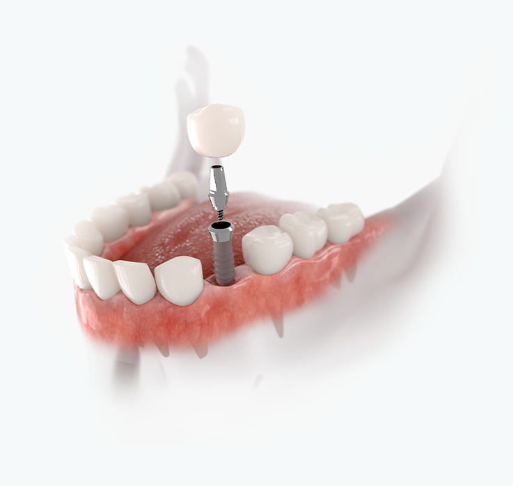 implantes-dentales-fijos
