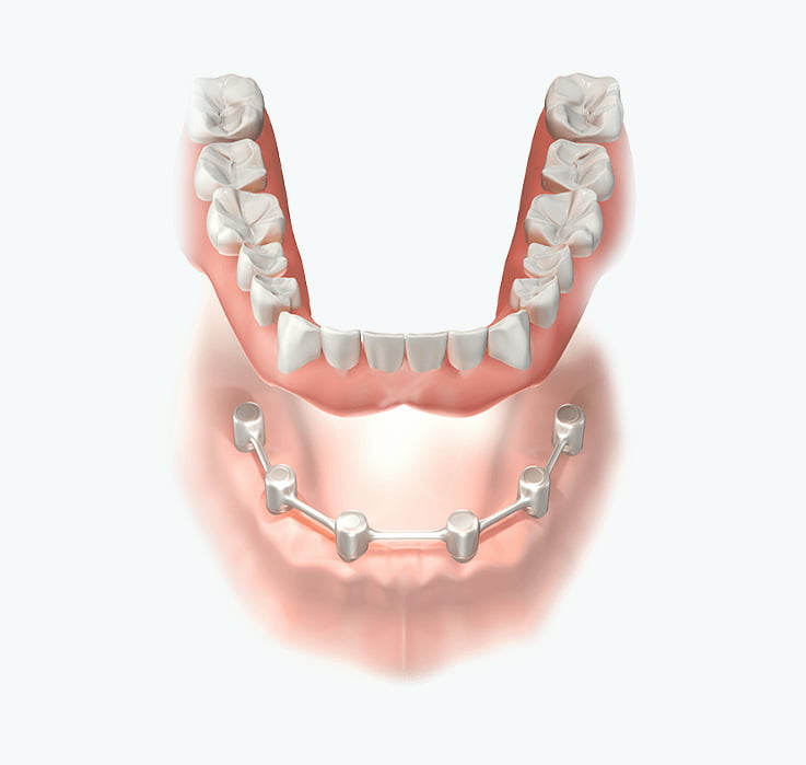 implantes-dentales-removibles
