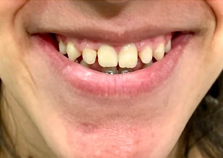implantes dentales antes de tratamiento