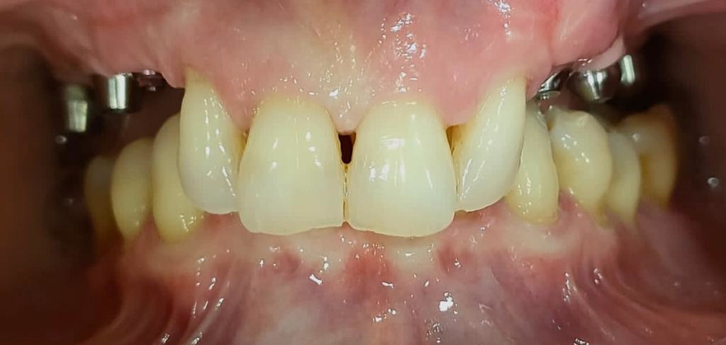 proceso de implantes dentales