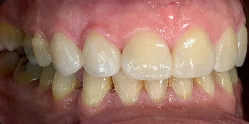 boca después de tratamientos con implantes dentales