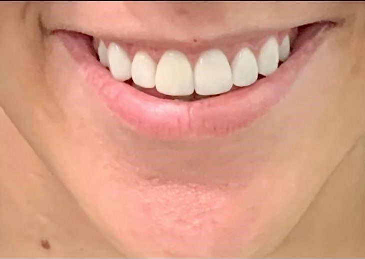 implantes dentales despues de tratamiento