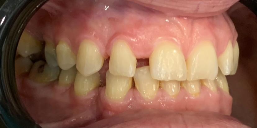boca tras impantes dentales