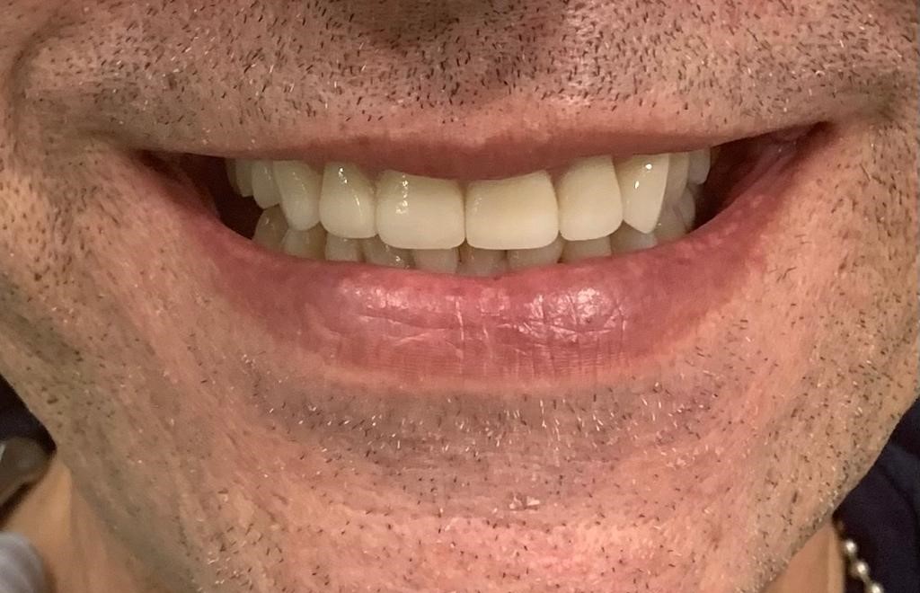 foto despues de tratamiento de implantes dentales
