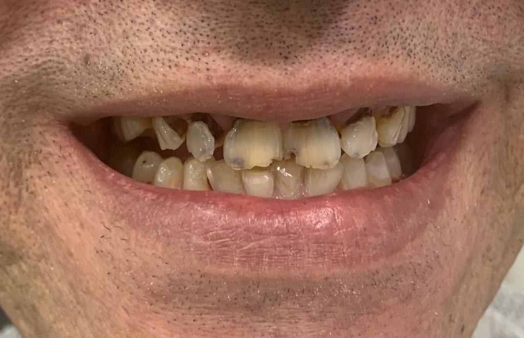 foto de dentadura antes de implantes dentales