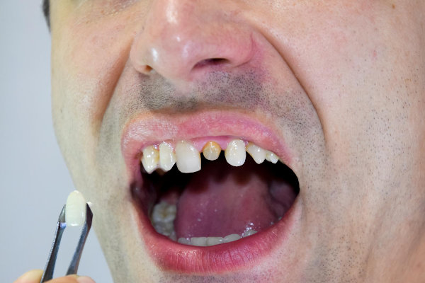 Incrustación dental cuándo se hace