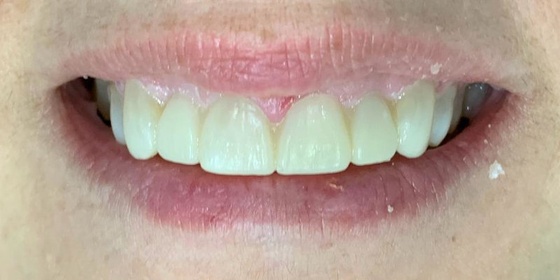 carillas dentales antes y despues